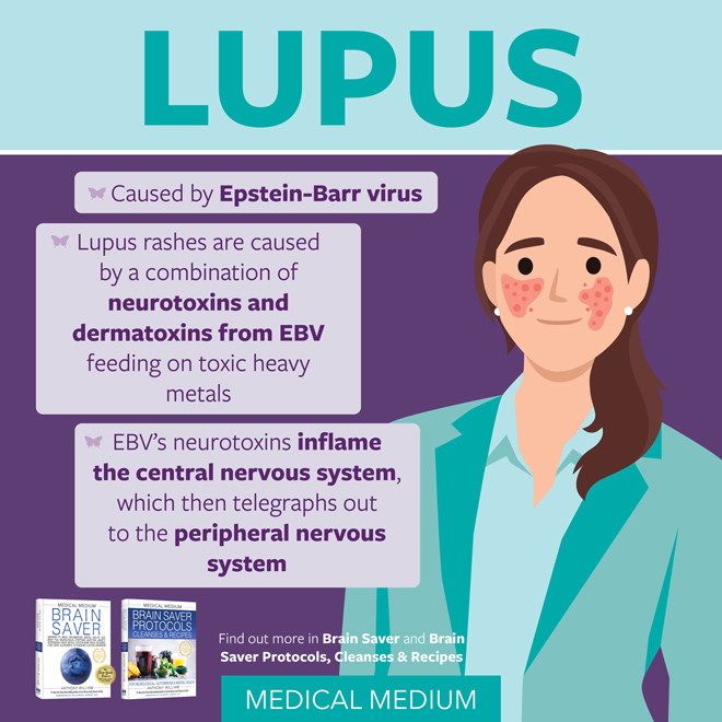 Lupus