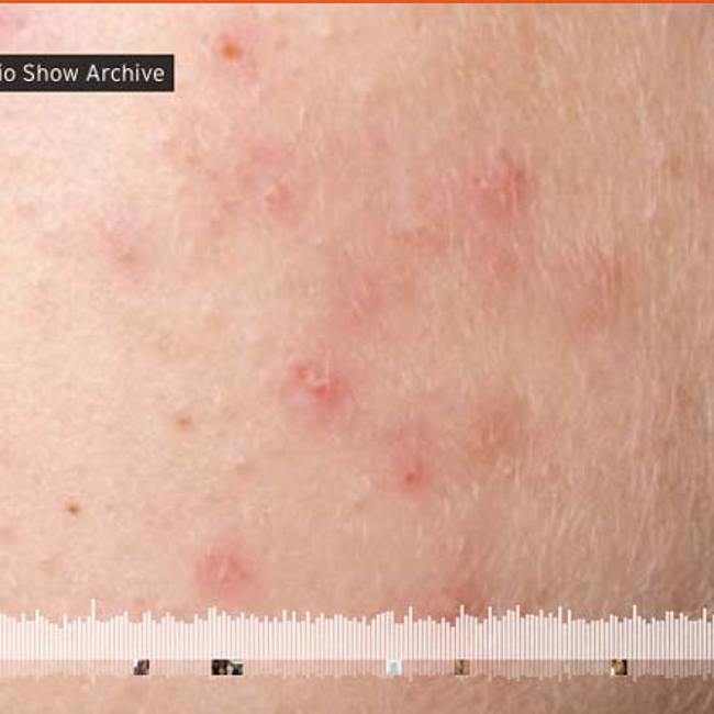 Healing Acne 